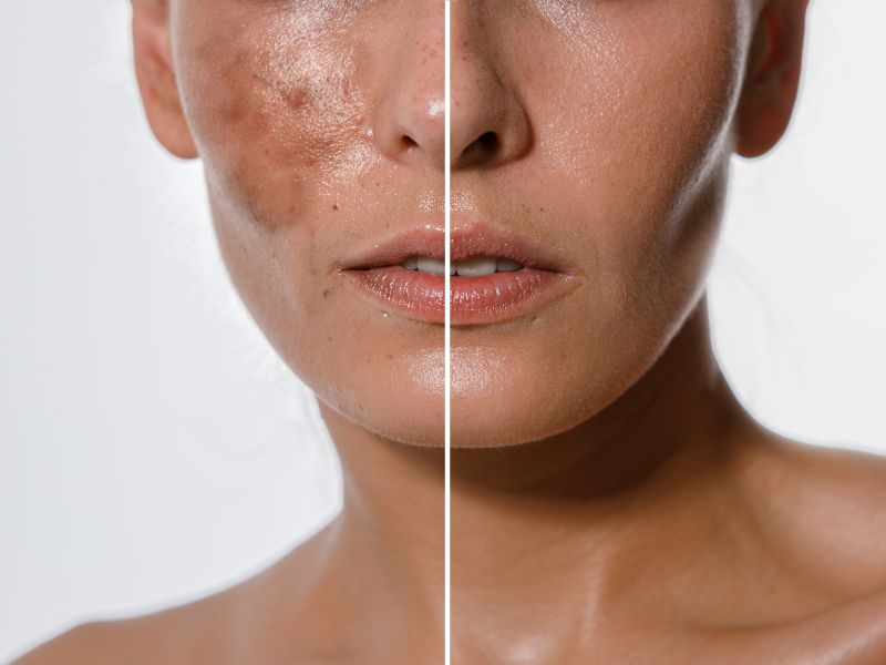 Using Cold Peel to Reduce Hyperpigmentation