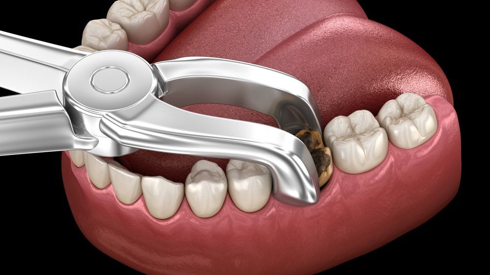 Tooth Extraction Cost and Healing Time
