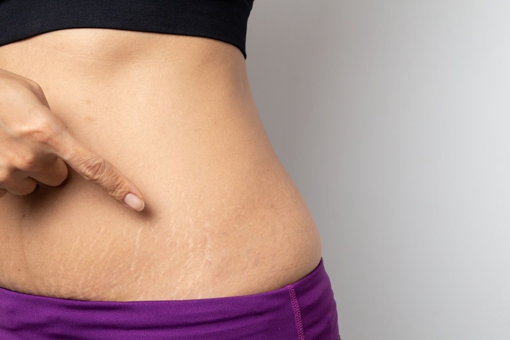 Preventing Stretch Marks Before Getting Laser Treatment