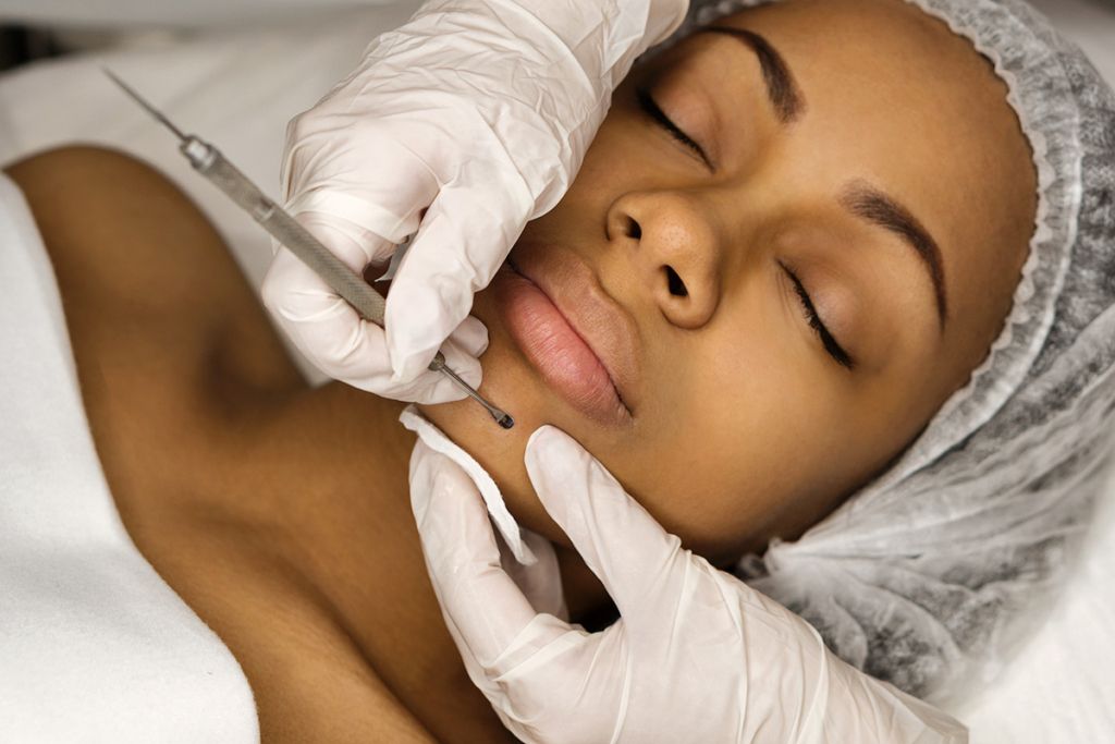 What to Expect During a Deep Cleansing Facial with Extraction