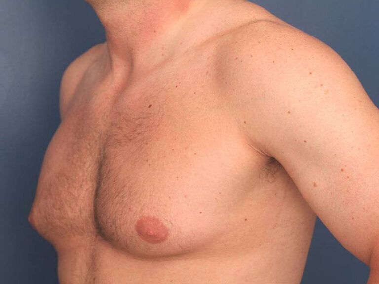 Imaging Techniques for Gynecomastia Diagnosis