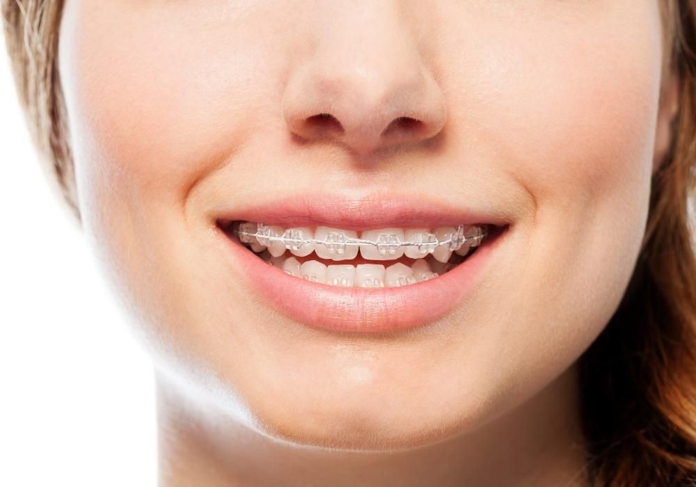 Dental Braces Adjustment: What You Need to Know