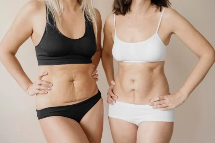 Liposuction for Specific Areas: Arms, Thighs, and Abdomen