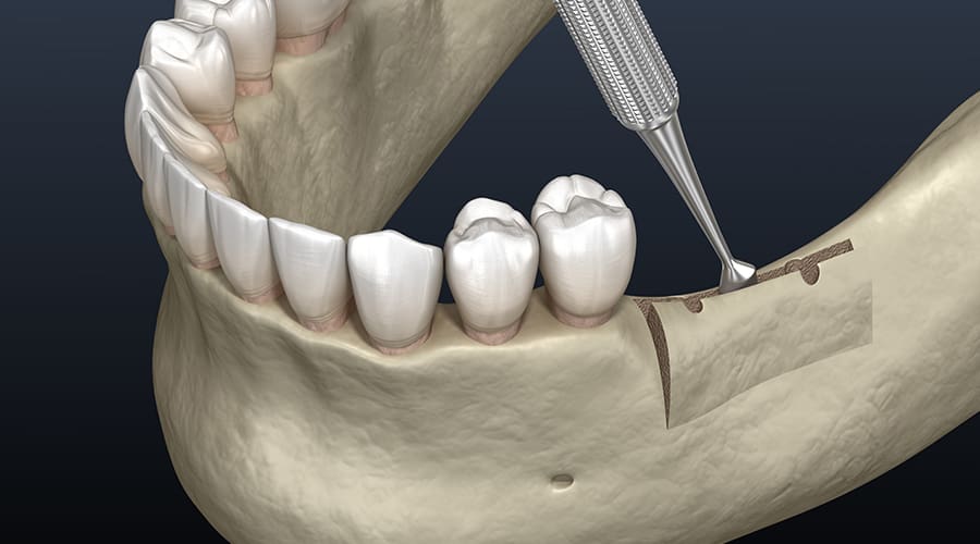 Early Symptoms That Lead to Wisdom Tooth Extraction