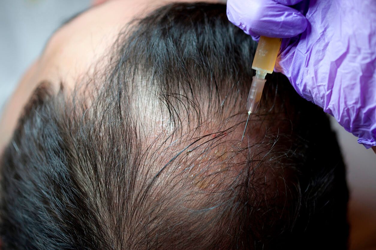 Can the Best PRP Hair Treatment Help with Alopecia Areata?