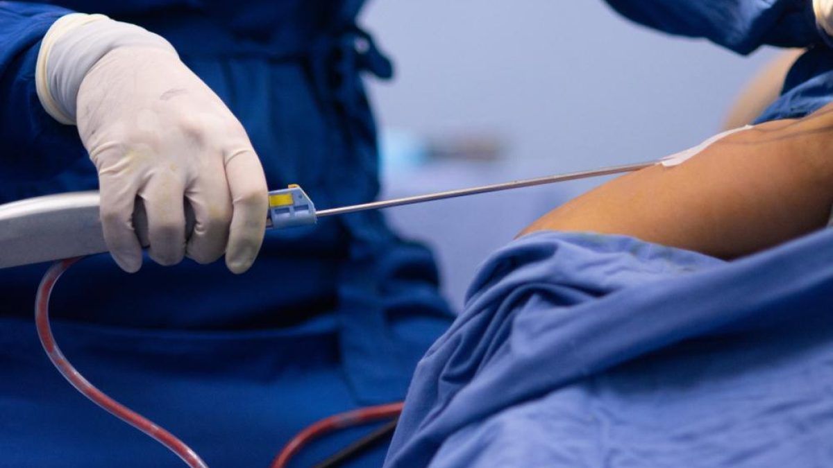 Power-Assisted Liposuction: What Makes It Different