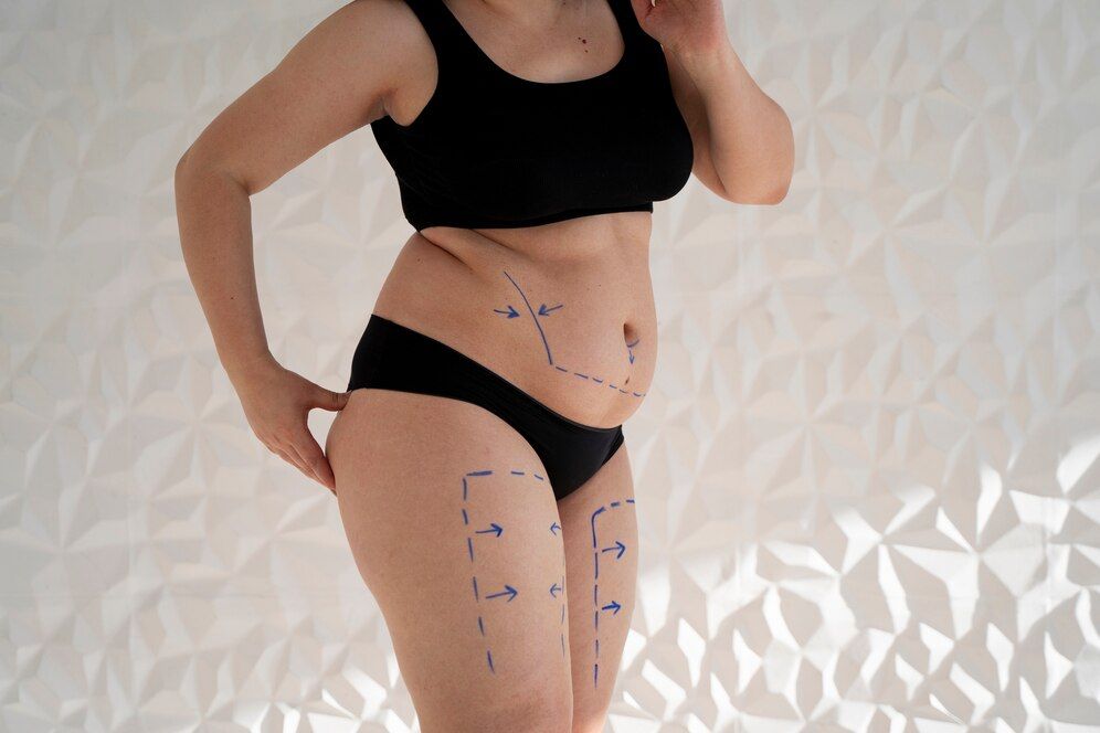 Can Liposuction Tighten Skin?