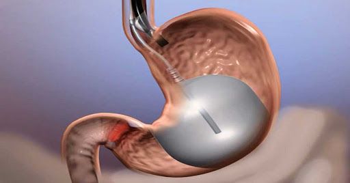How Much Weight Can You Lose After Gastric Balloon Placement?