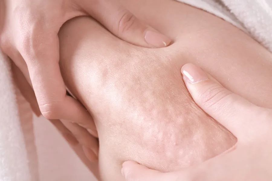 Cellfina Treatment for Cellulite: Does It Really Work?