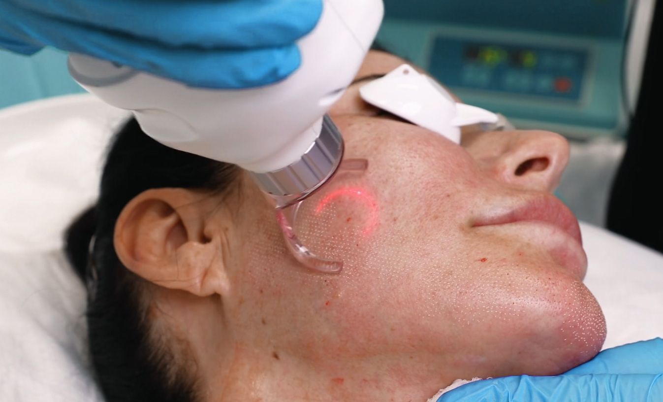 Fractional CO2 Laser Treatment Results Timeline Explained